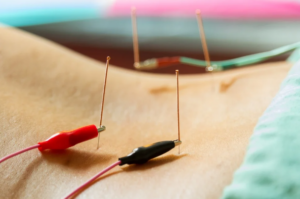 Electro acupuncture therapy