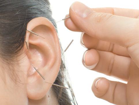 auricular acupuncture therapy